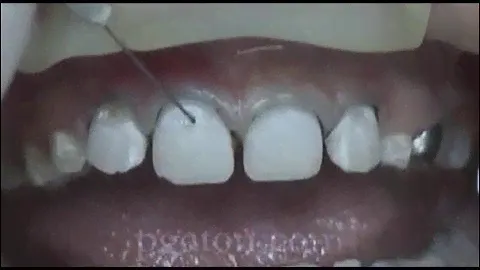 Micro-invasive treatment of white spot with resin infiltration ICON DMG