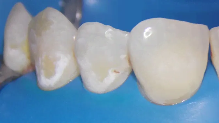 ICON Resin Infiltration step by step Microscopic Dentistry