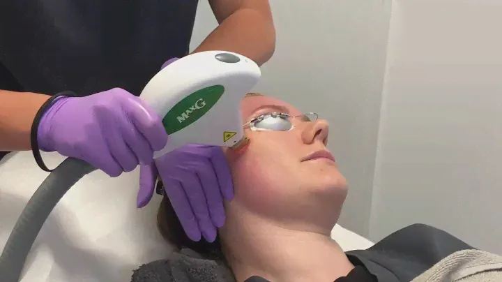 Cynosure ICON MAXG IPL Treatment | The Laser and Skin Clinic